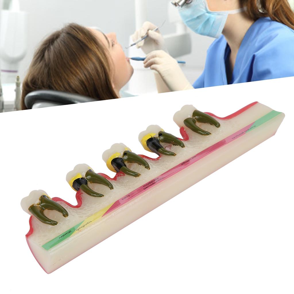Dental Periodontal Disease Model Tooth Disease Study Teaching Model for Dental School