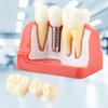 1pc Resin Dental Demonstration Tooth Model Implant Analysis Crown Bridge for Dentist