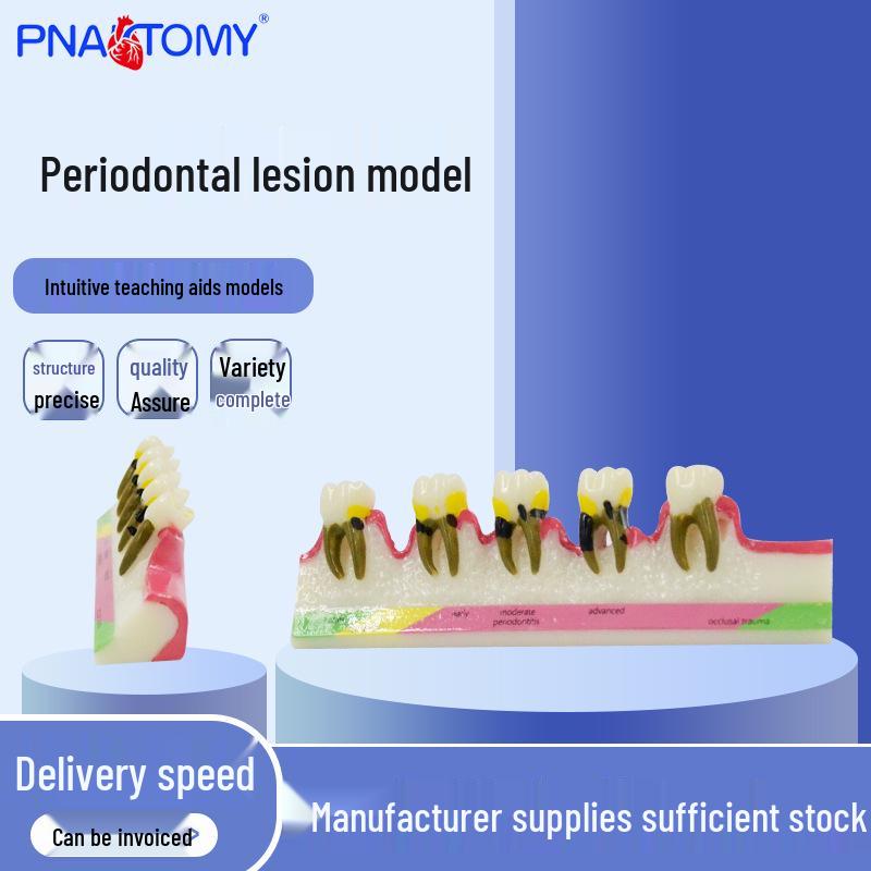 PNT-OR13 Resin Adult Periodontal Lesion Dental Teaching Model Resin