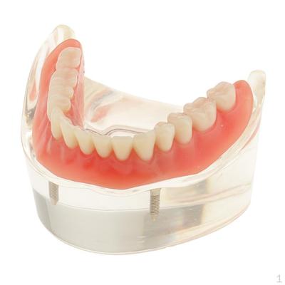 Badanie zębów jamy ustnej Nauczanie demonstracji Model Overdenture Gorszy 2 Implant Demo Nauczanie -