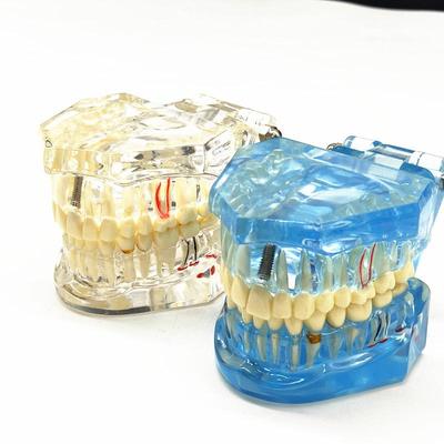 1 Piece Dental Implant Disease Teeth Model With Restoration Bridge Tooth Dentist For Medical Science Dental Disease Teaching Study