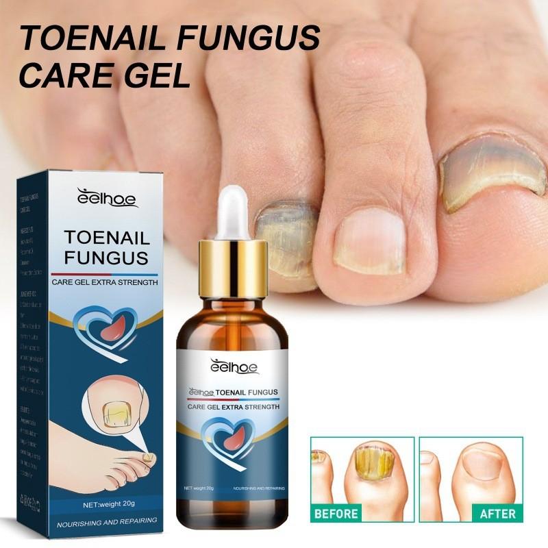 Eelhoe Toenail Care Gel For Yellow Thickened Nails With Fortifying And Restorative Formula
