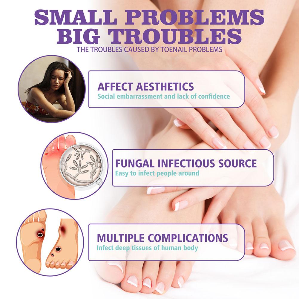 1/3/5PCS Nail Fungus Spray Reduce Beriberi Deodorize Remove Onychomycosis Paronychia Deeply Mild Cleansing Nail Care Spray