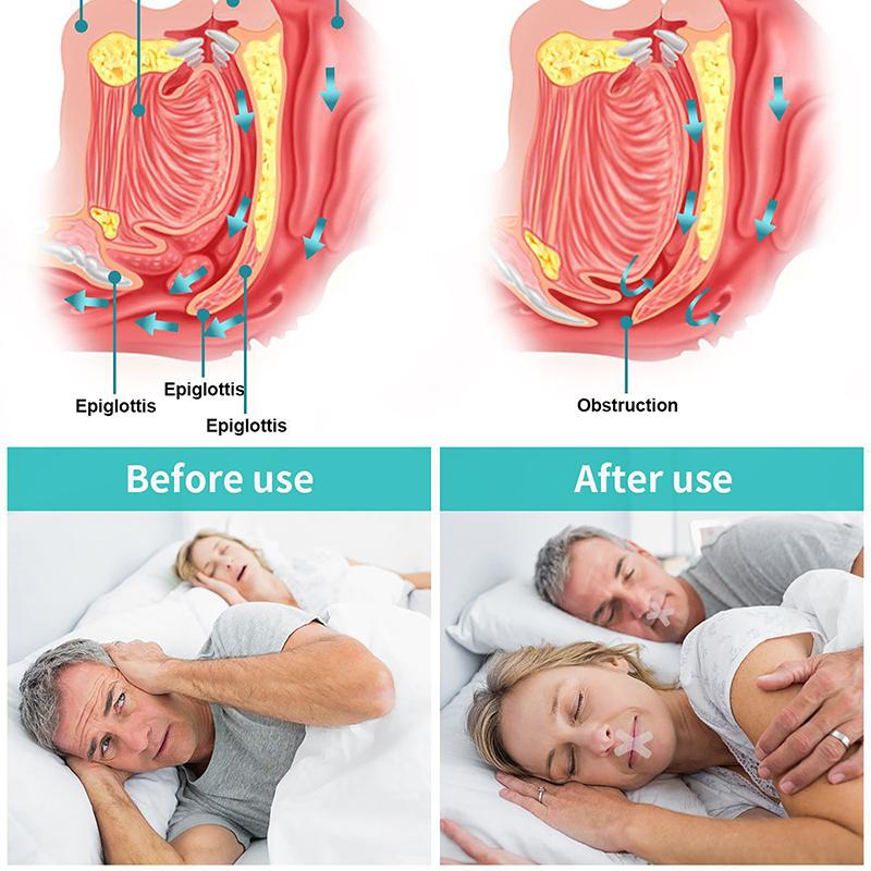 Anti Snoring Mouth Tape Sleep Aid Breathing Stopper Nose HealthCare Sticker Better Breath Nasal Strip Close Solution Night Patch