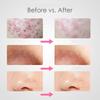 7PCS Blackhead Extractor Kit Facial Black Dots Remover Comedone Tweezer Pimple Blamish Skin Care