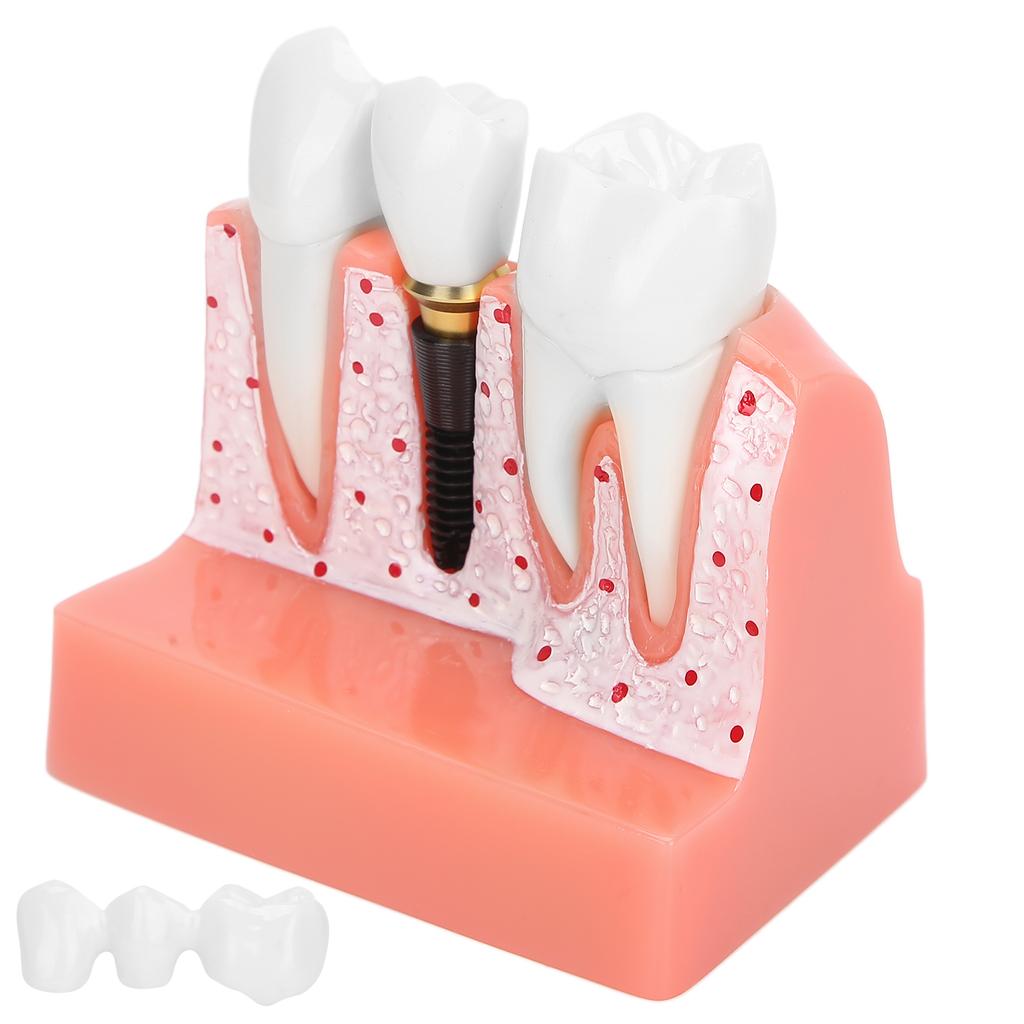 Model zubů Analýza zubního implantátu Demonstrační model korunkového můstku Model zubu