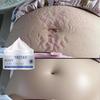 Pregnancy Repair Cream Stretch Mark Removal Removal Acne Scar Stretch Marks Cream Fat Striae Gravidarum Treatment Body Creams