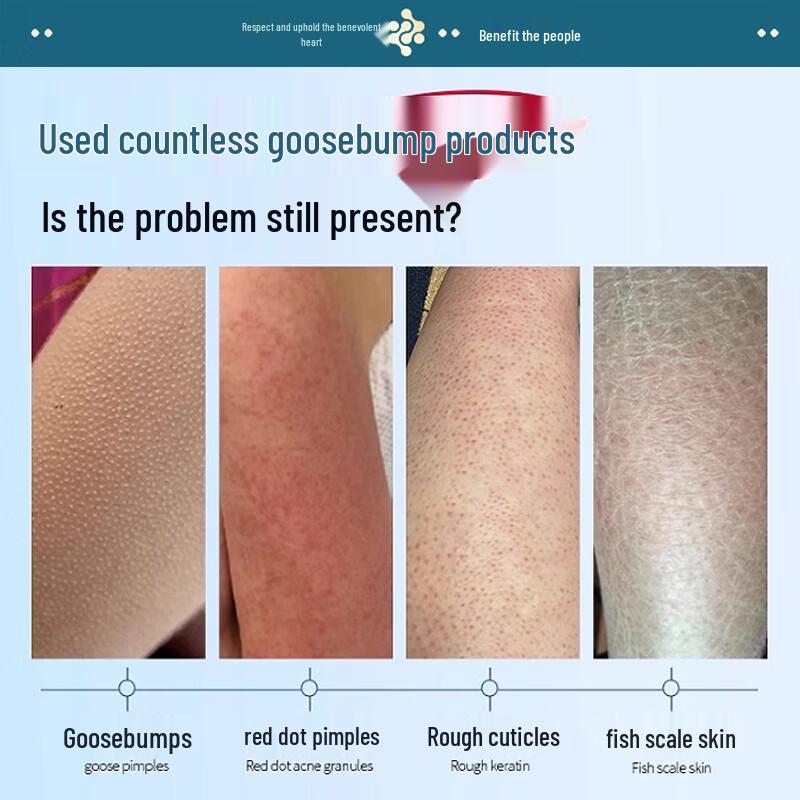 Behandlungskörperseife für Keratosis Pilaris