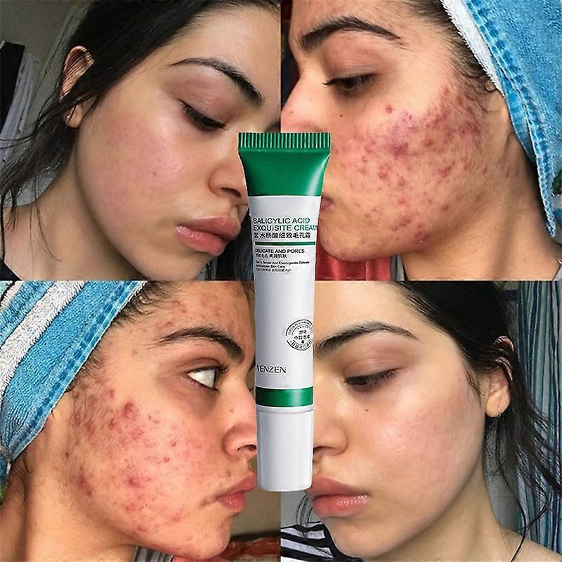 Pores Shrink Cream Moisturizing Acne Improve Acnes Blackheads Whitening Cream Anti-aging Oil Control Skin Care