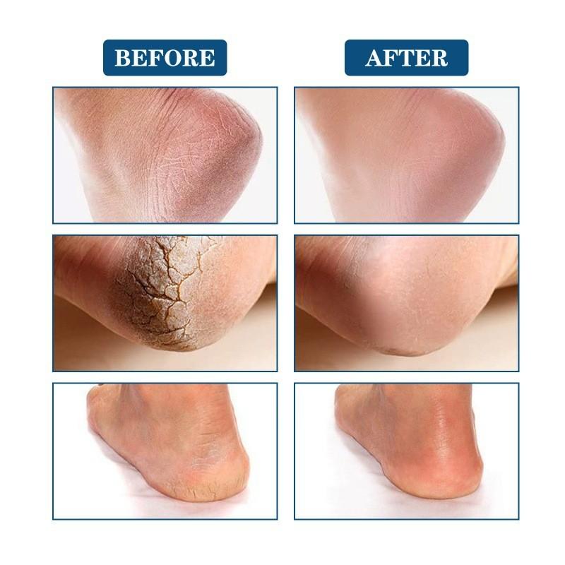 Jaysuing Advanced Foot Care Spray Moisturizes Hydrates And Prevents Dry Cracked Feet And Calluses