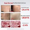 Professional Laser Spot Removal Beauty Device CN plug (adapter included)
