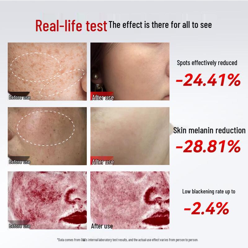 Professional Laser Spot Removal Beauty Device CN plug (adapter included)