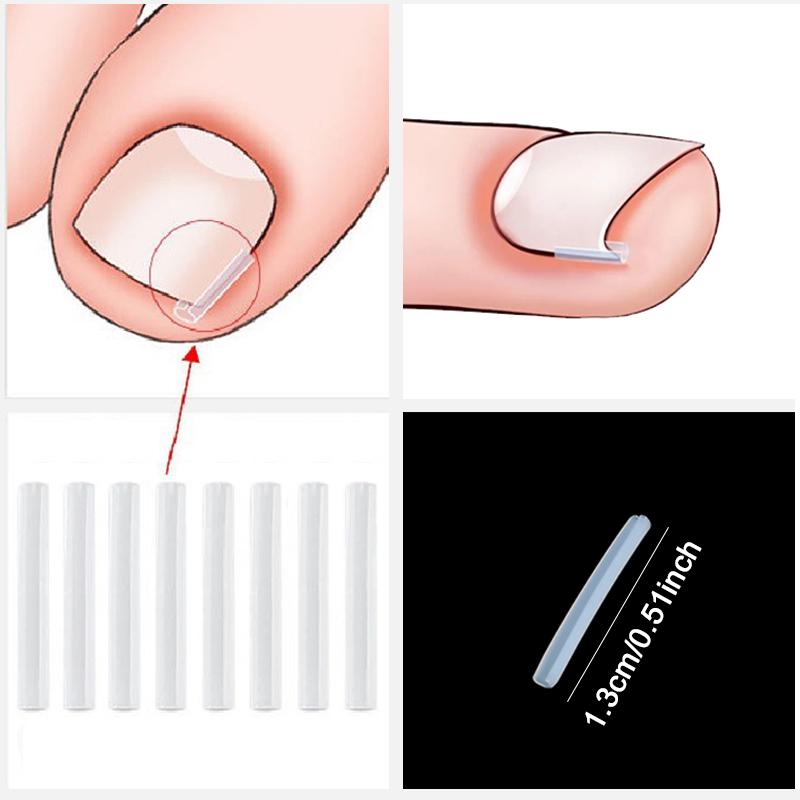 Ingrown Toenail Correction Tool Elastic Patch Nail Filling Pad Toe Straightening Clip Brace Ingrown Nails Pedicure Treatment