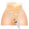 150/200//250/300/350/500ML Easy Insertion Anal Flusher Precise Scale Effortless Feces Drainage Anal Flusher