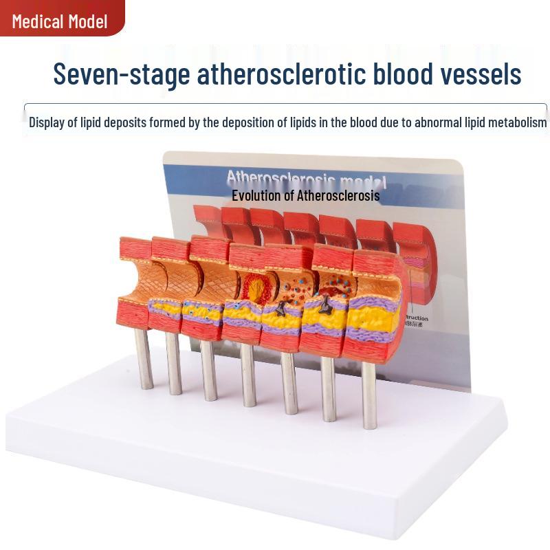 Seven Stages of Blood Lipid Changes: Human Vascular Pathology and Atherosclerosis