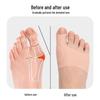 Soft Orthotic Big Toe Corrector for Bunion and Hallux Valgus Care