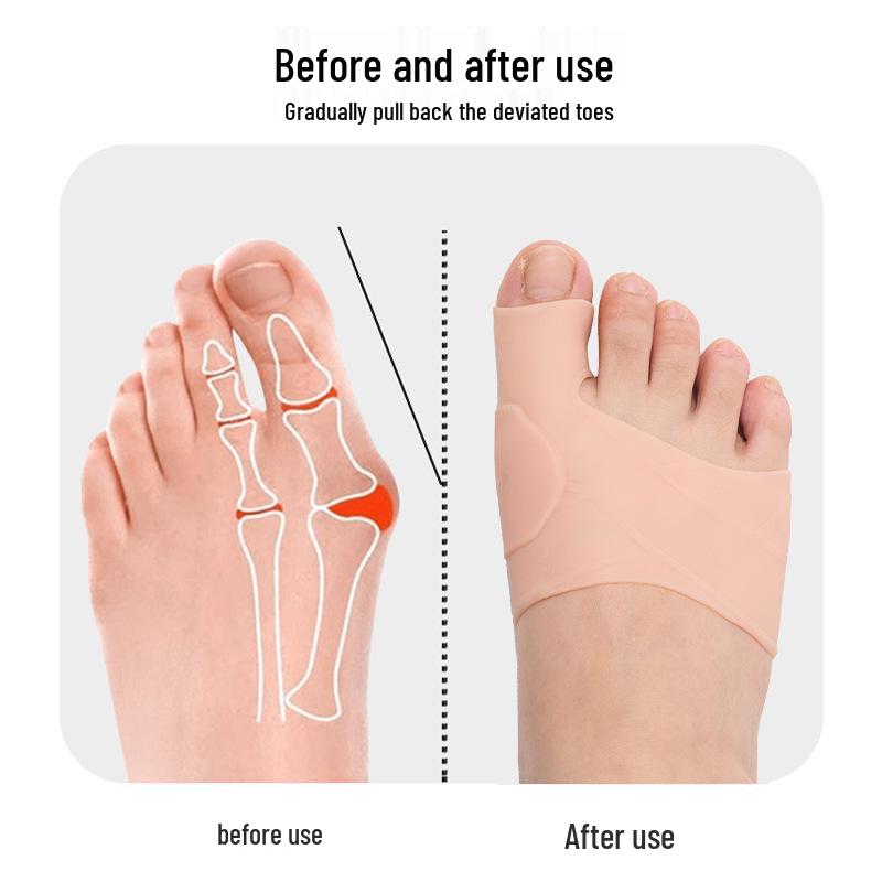 Soft Orthotic Big Toe Corrector for Bunion and Hallux Valgus Care