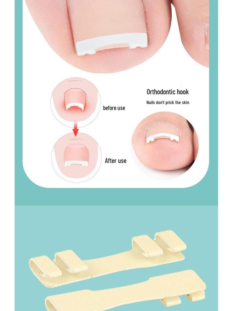Nickel-Titanium Ingrown Toenail Corrector: Invisible, Wearable Nail Hook for Pain Relief
