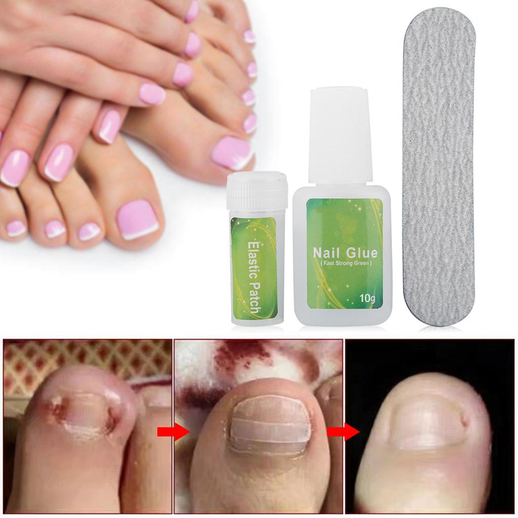 Ingrown Toenails Physical Correcting Elastic Patches Pedicure Tool Kit Correction Set