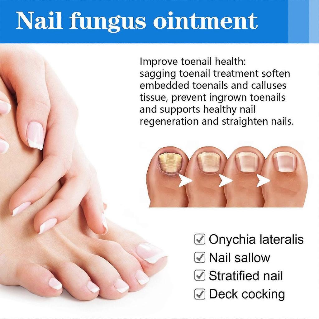 Ximonth Nail Care Cream - Repairs Gray Nails, Ingrown Nails, Soft Or Thickened Nails, Relieves Swelling And Pain