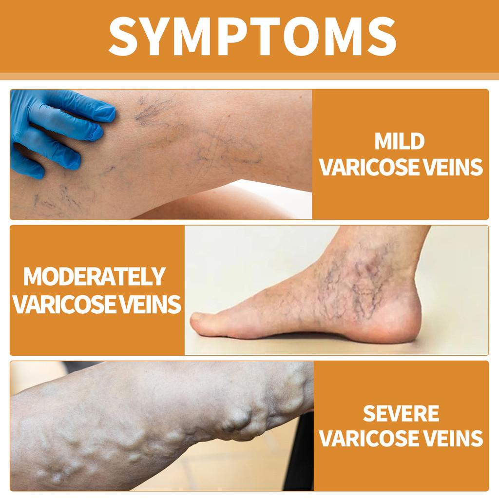 Premium Varicose Vein Repair Cream Relieves Soreness Swelling And Bulging Veins