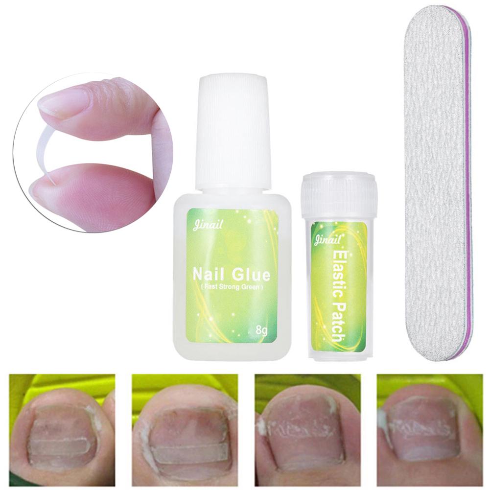 Clinging 12Pcs Ingrown Toenail Correction Pedicure Tool Elastic Patch Straightening Clip