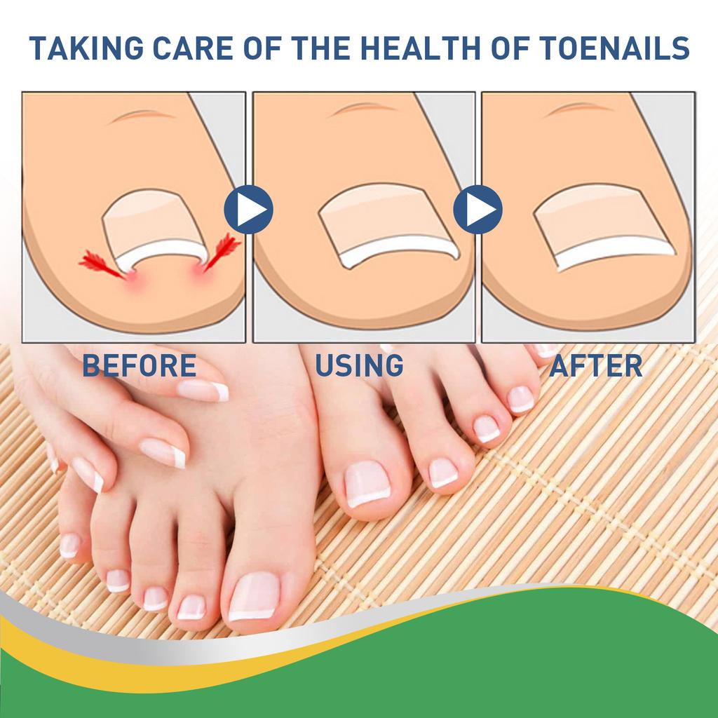 50 Pcs/Set Nail Ingrown Stickers Double-sided Adhesive Ingrown Toenail Correction Ingrown Toenail Correction Tool Elastic Patch Stickers