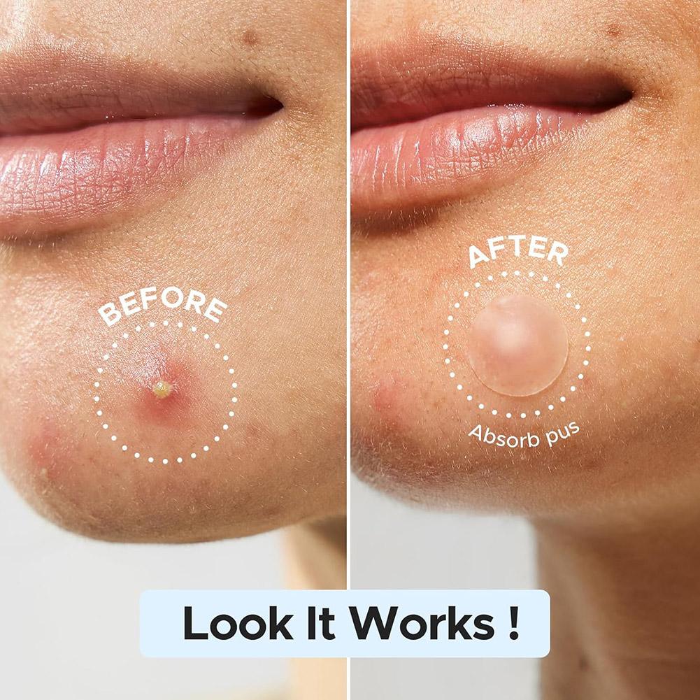 Large capacity Pimple Patches for Acne & Blemishes Various Shapes Covering Acne and Spot Patches for Face Skin Care Tool