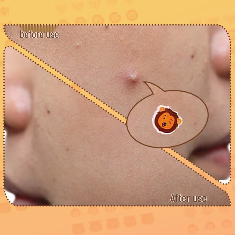 AUSLKA Beauty Cute Animal Acne Patches