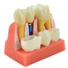 Dental Teach 4 Times Implant Analysis Crown Bridge Removable Model Dental Demonstration Teeth Model Dentisty Lab Material