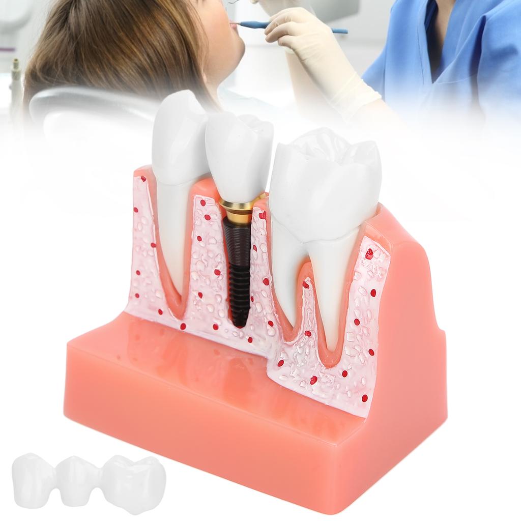 Model zubů Analýza zubního implantátu Demonstrační model korunkového můstku Model zubu