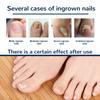 50Pcs Ingrown Toenail Sticker Strong Adhesion Safe Breathable Easy to Use Toenail Corrector Patch for Toenail Correction