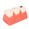 Modelo de Caries Dental Modelo de Demostración de Decaimiento Dental Modelo de Dientes Desmontable de Simulación