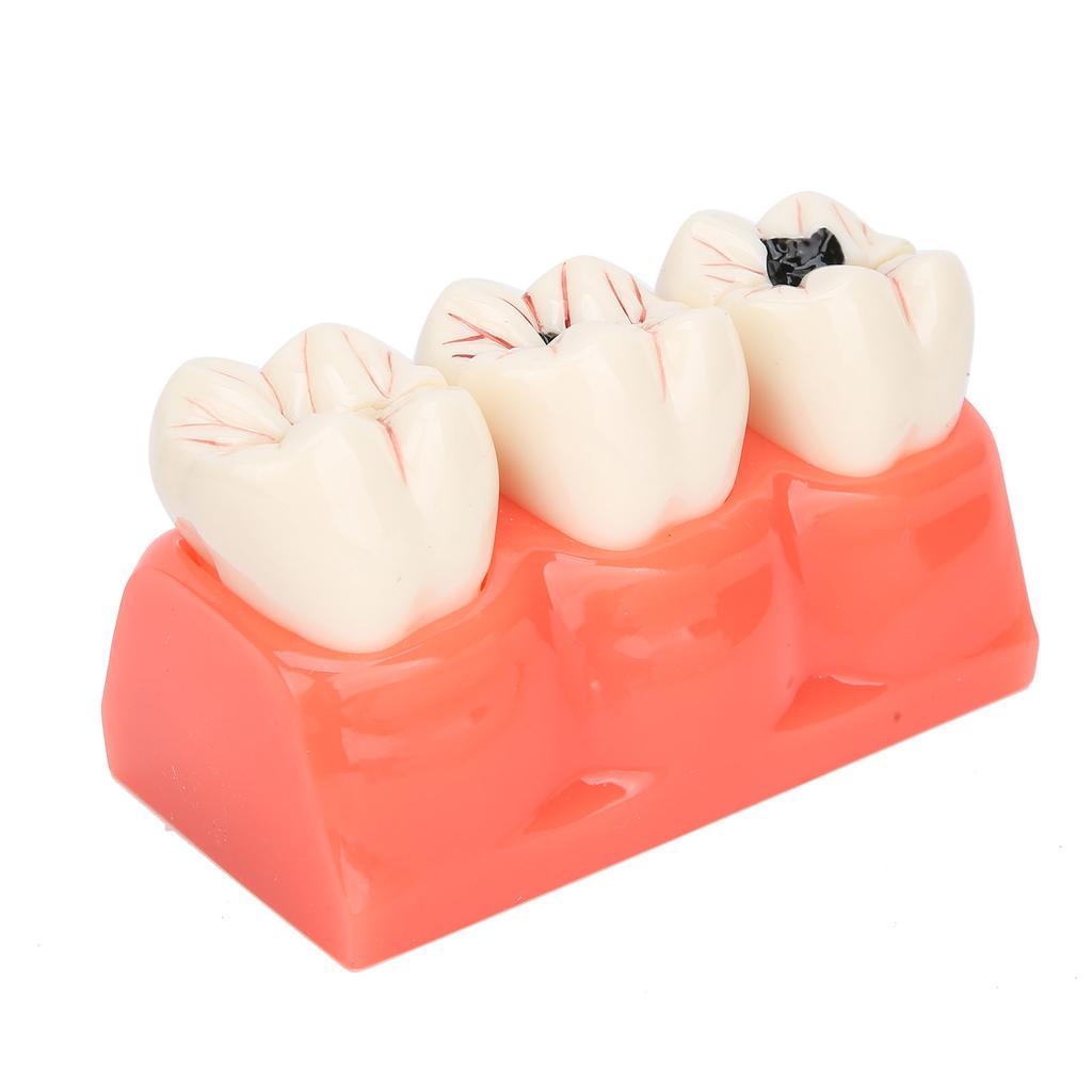 Modelo de Caries Dental Modelo de Demostración de Decaimiento Dental Modelo de Dientes Desmontable de Simulación
