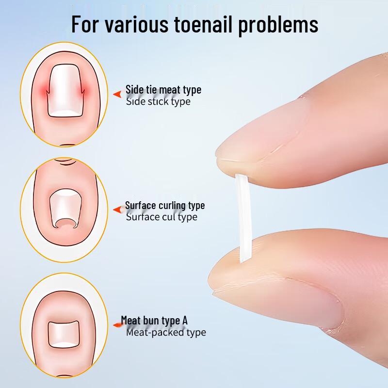 Ingrown Toenail Correction & Repair Kit