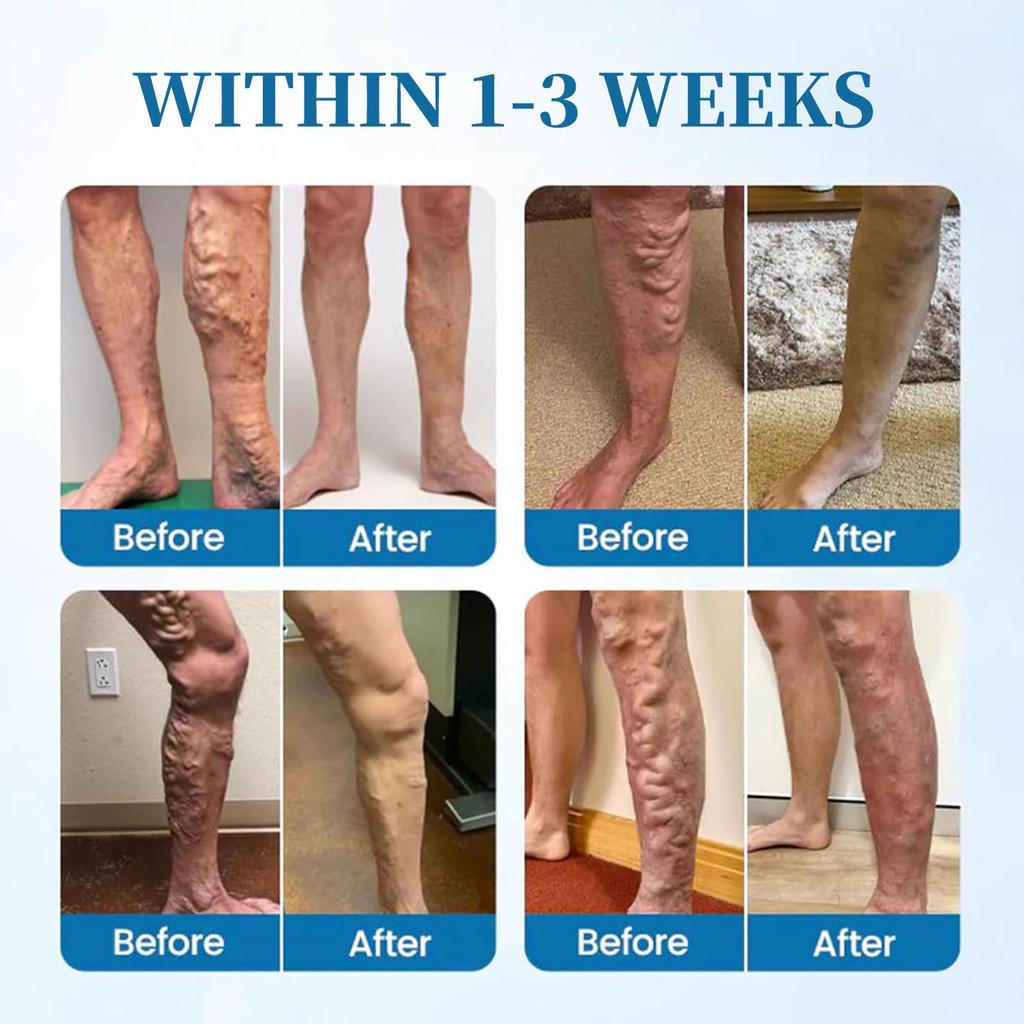 Varicose Veins Cream-Improve Blood Circulation-Relief Swelling And Pain-Minimize Varicose Vein & Spider Vein, 50g