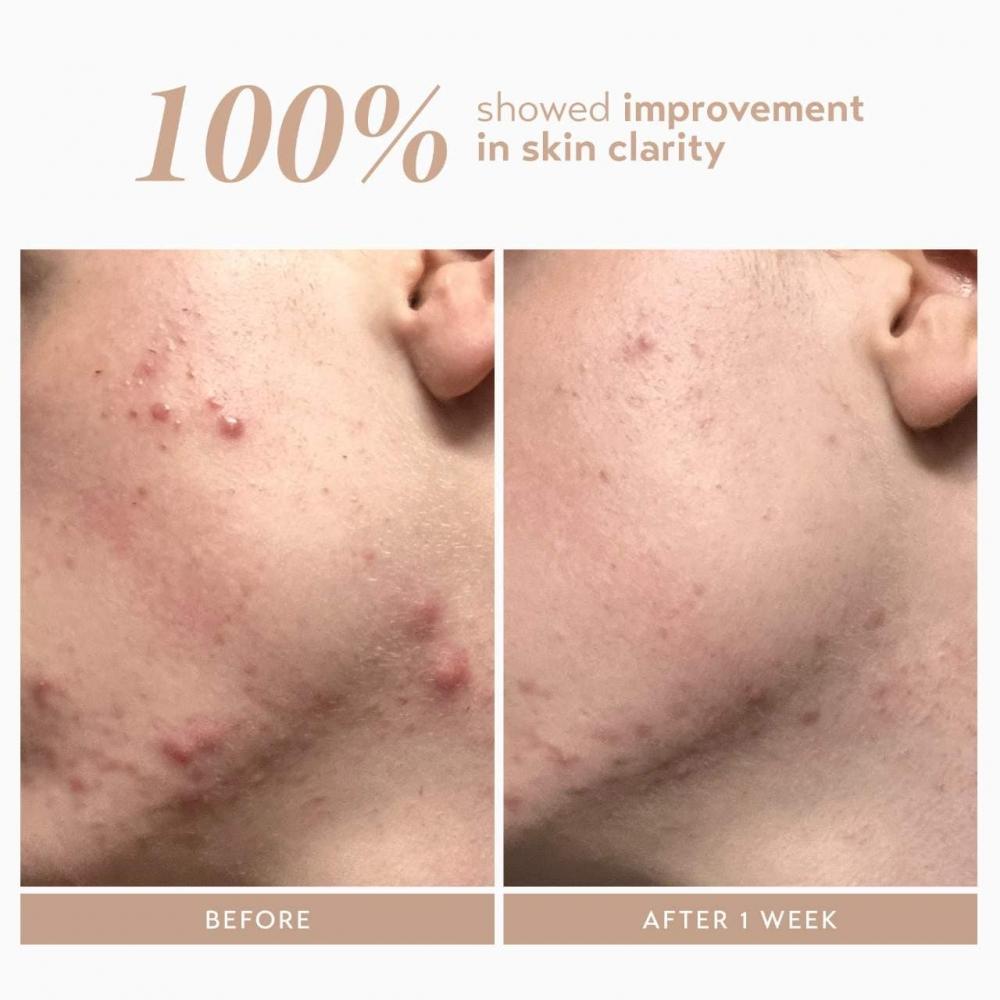 Shani Darden Skin Care Rescue Serum 10 Azelain-Komplex Gegen Pigmentflecken 1 Unze 30 ml