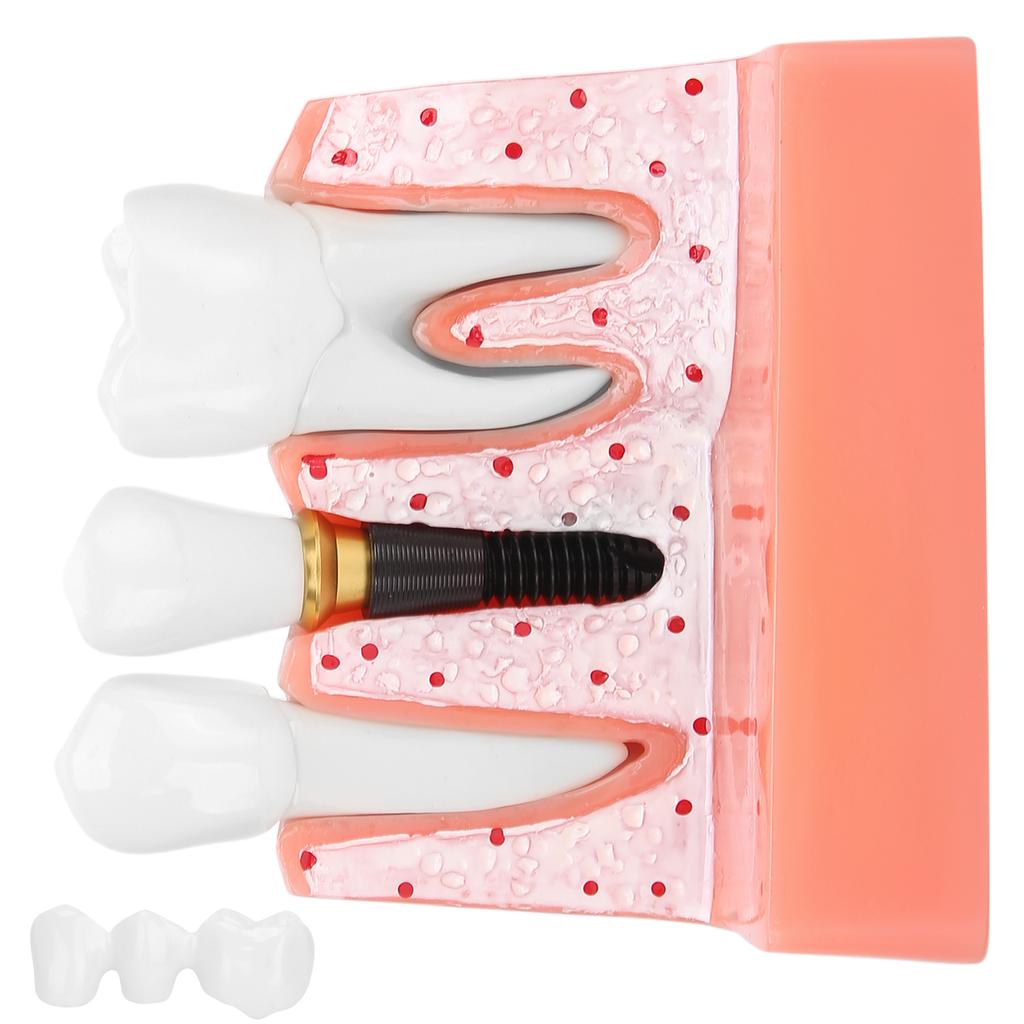 Model zubů Analýza zubního implantátu Demonstrační model korunkového můstku Model zubu