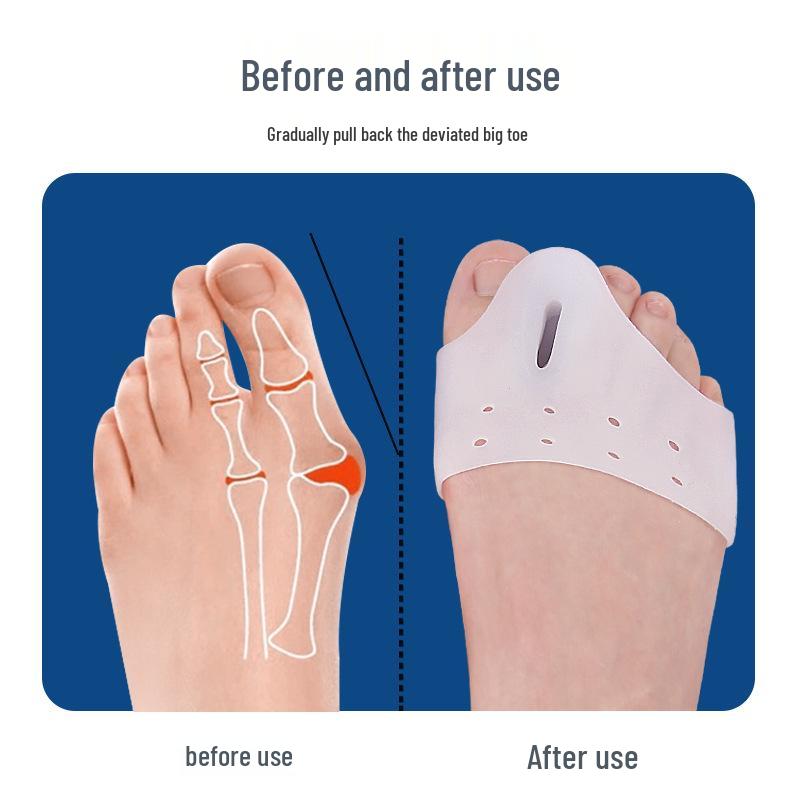 Hallux Valgus Toe Separator & Padded Arch Support with Forefoot Massage Pad - Bunion Corrector for Day & Night Use