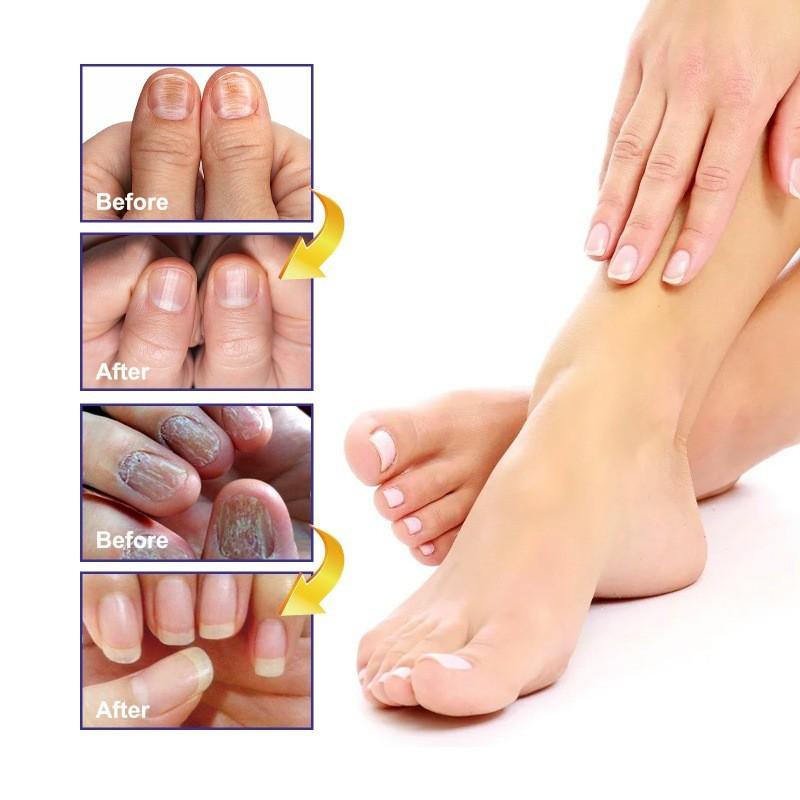Ouhoe Nail Repair Solution Thickening Treatment For Ingrown Nails And Fungal Issues