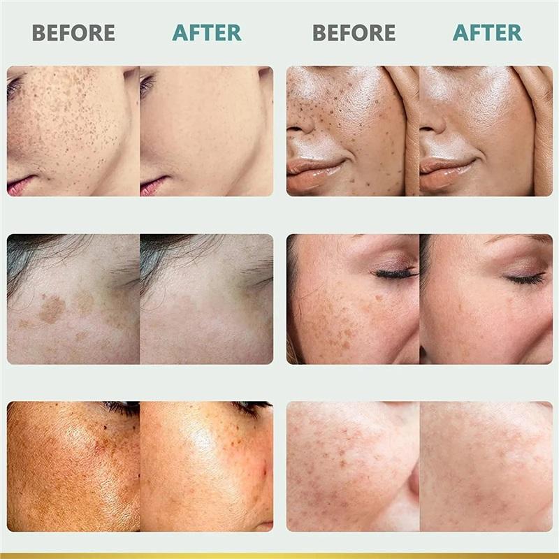 Whiten Cream Brighten Face Effective Remove Melasma Dark Spot Improve Dullness Skin Anti-pigmentation Care Cream Care Products