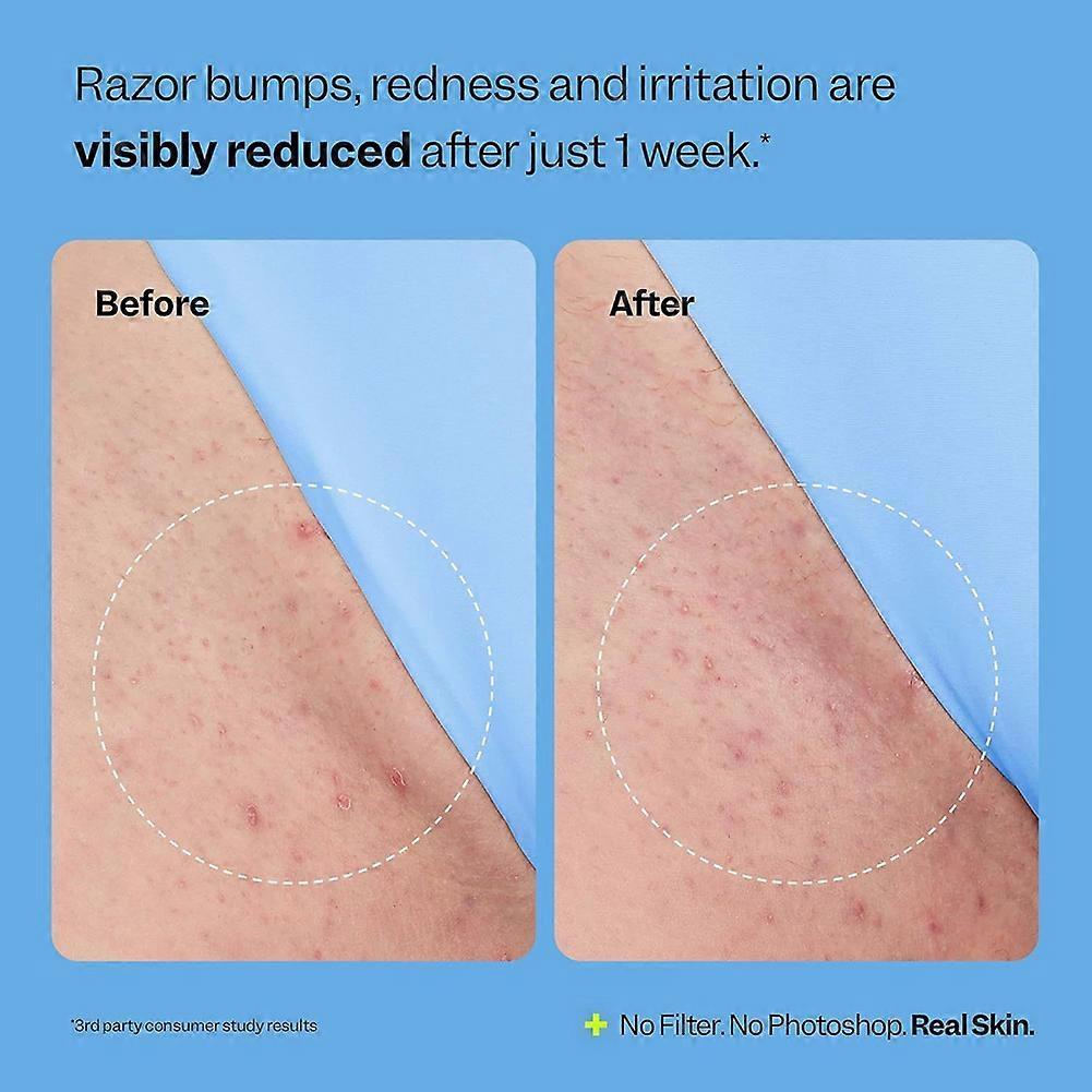 Sérum de Tratamento para Pelos Encravados 50ml para Virilha Axilas e Pernas Alívio da Vermelhidão com Extratos Naturais de Plantas Não Oleoso de Rápida Absorção Suave