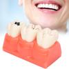 Dental Caries Model Tooth Decay Demonstration Model Simulation Detachable Teeth Model