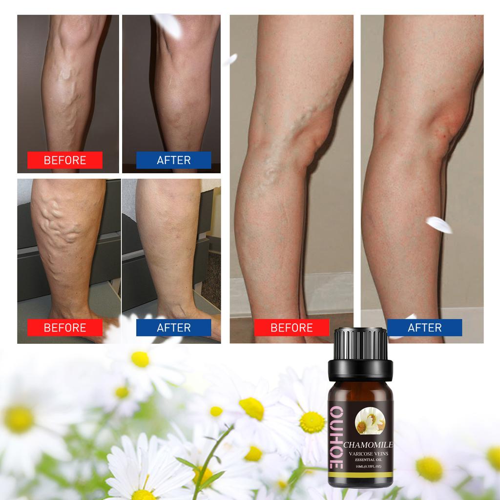 OUHOE Chamomile Essential Oil for Varicose Veins 10ml