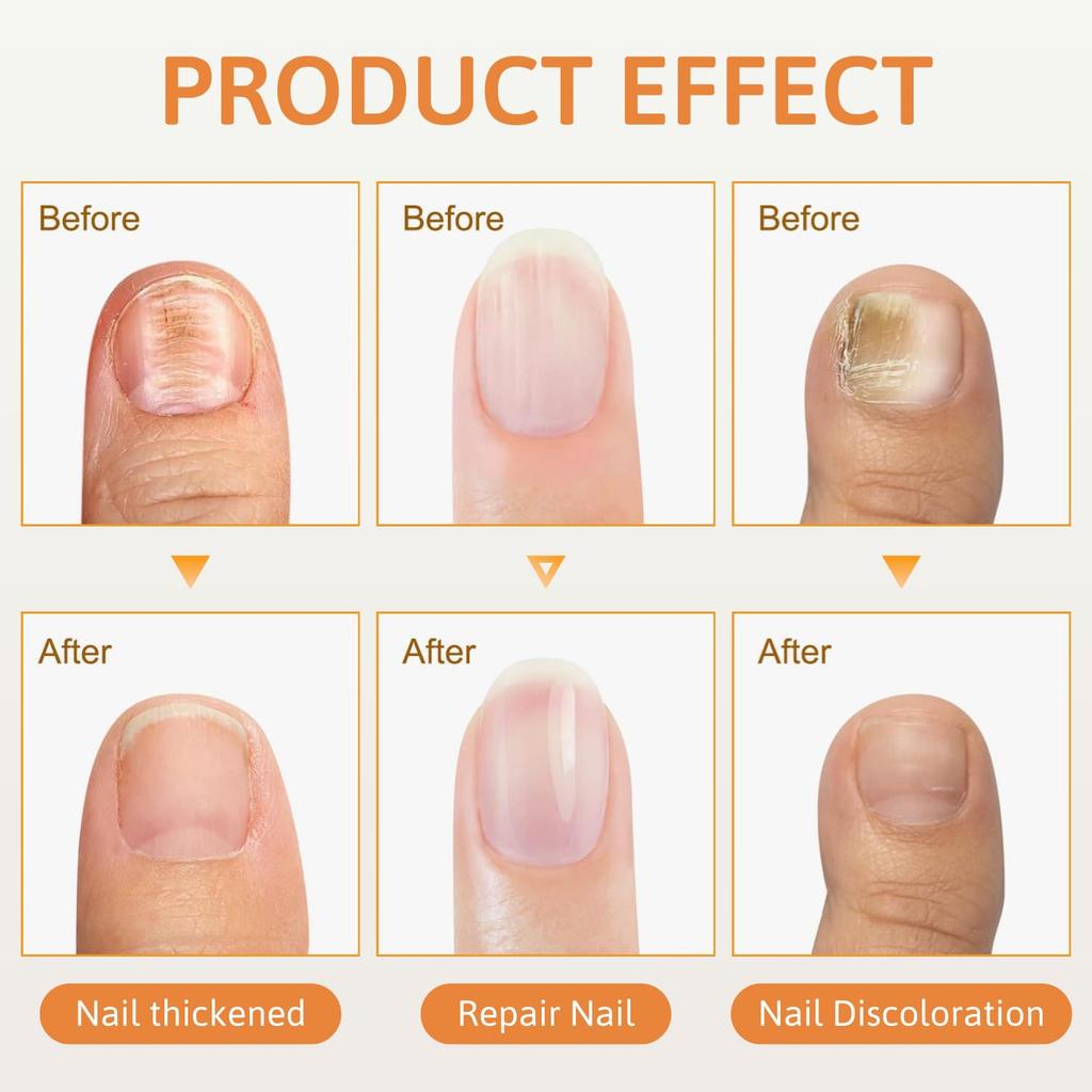 2Pcs Bee Venom Nail Soothing Spray, Advanced Nail Repair Spray, Bee Venom Toe Nail Treatments spray, Nail Care, Gently and Nourishing
