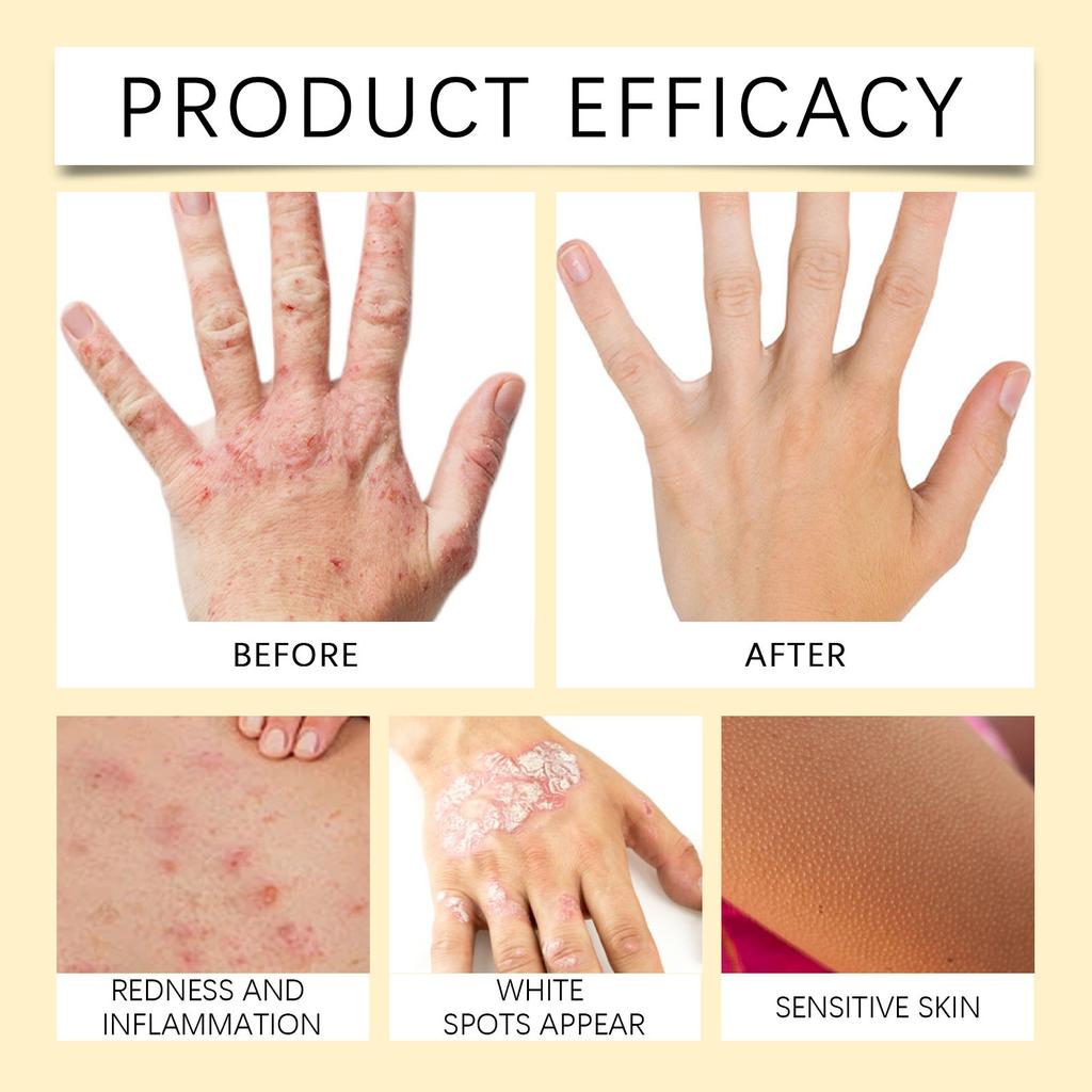 Promote Metabolism, Reduce Inflammation, And Help Reduce The Area Of White Spots.help Reduce Pigment In Areas Of White Spots