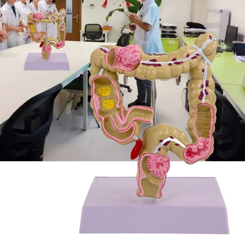 Menschliches Dickdarmmodell für Anatomie, Medizin, Lehrmodell, Pathologien des Dickdarmmodells für Studium und Ausstellung