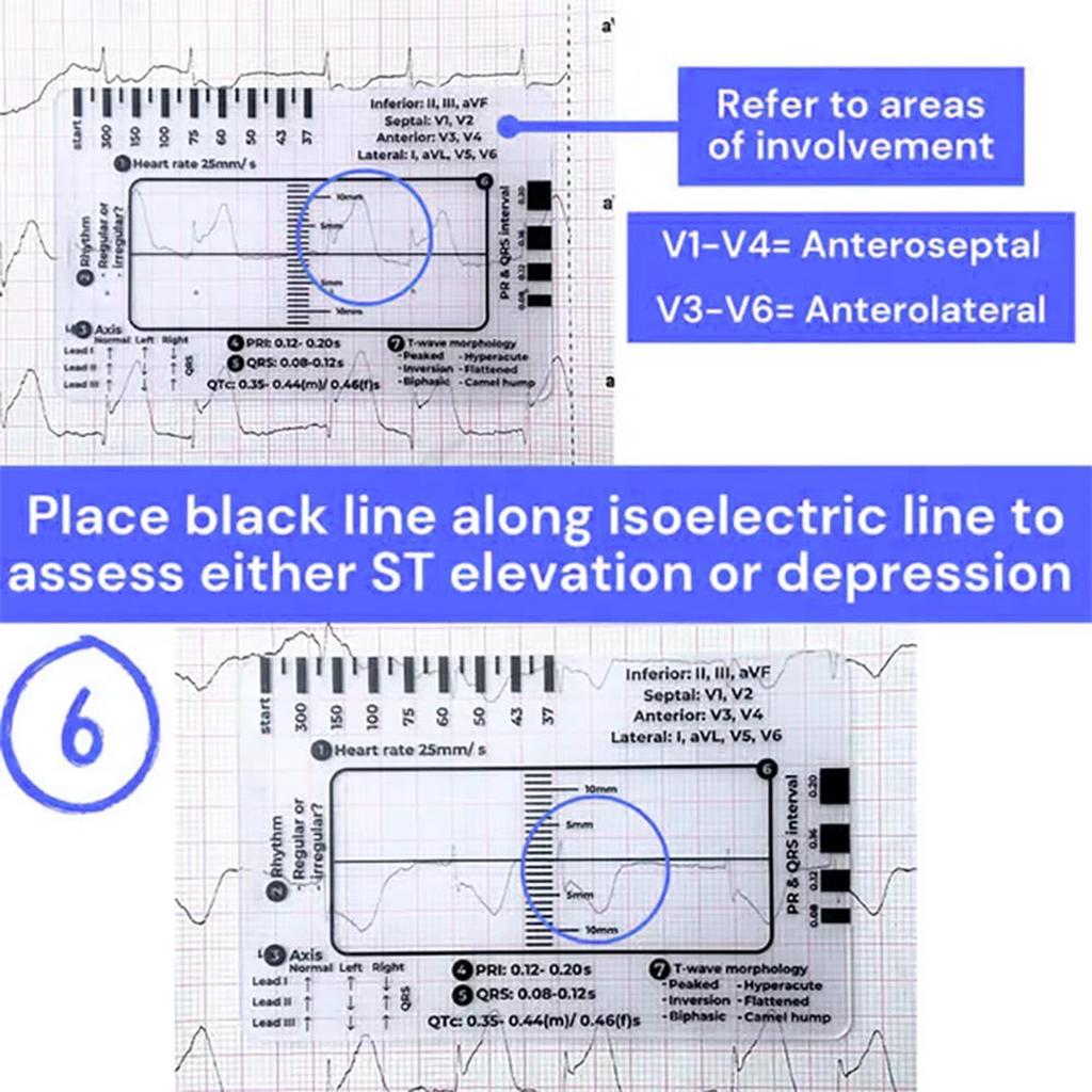 Professional Pocket Card 7 Step Ruler For Easy Electrocardiogram Assessment Reference Guide Efficient Heart Data Reading