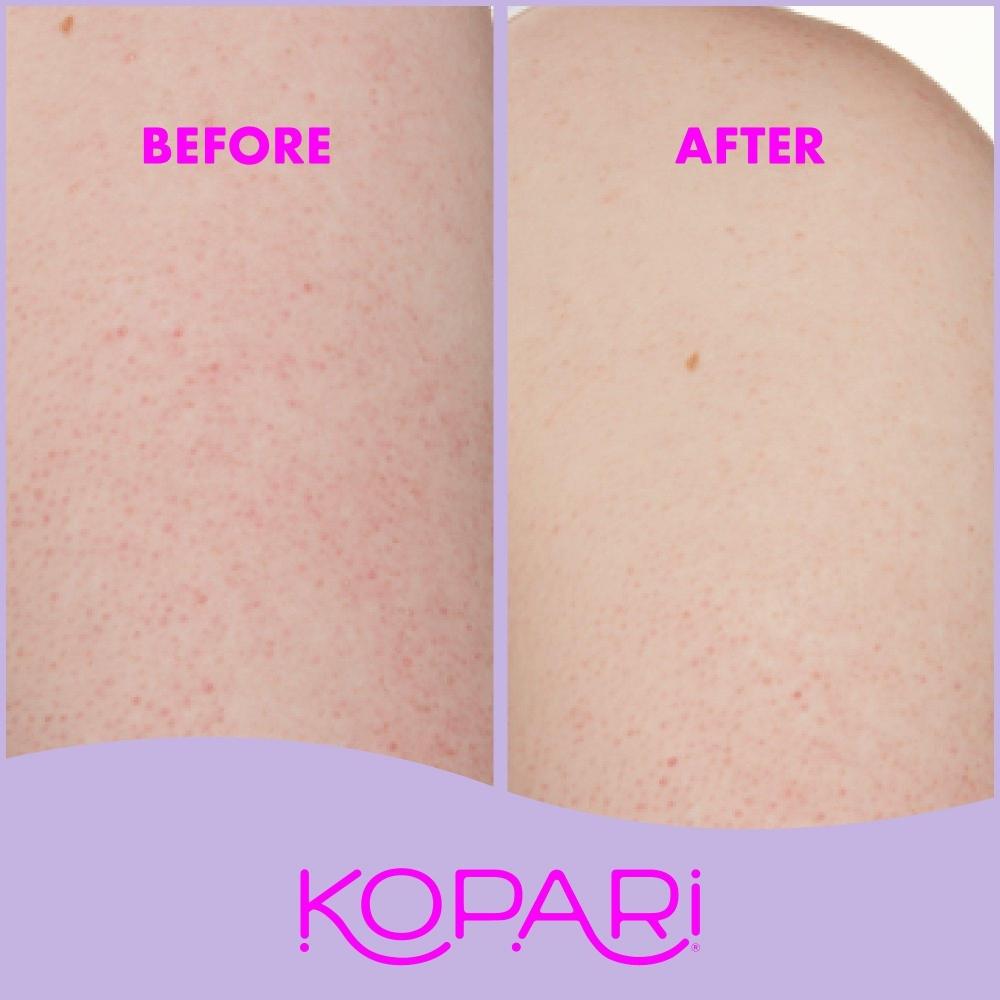 Kopari Beauty Kp Body Bumps Be Gone With 10  Aha 8.45 Oz