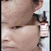 Dark Spot Corrector Cream, Ingredient, Enriching Skin Care For All Skin Tones, Melasma, Freckle, Sun Spot Improving For Women And Men